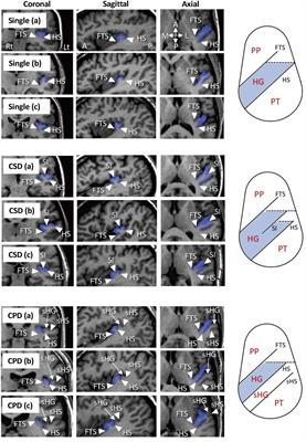 Different Frequency of Heschl’s Gyrus Duplication Patterns in Neuropsychiatric Disorders: An MRI Study in Bipolar and Major Depressive Disorders